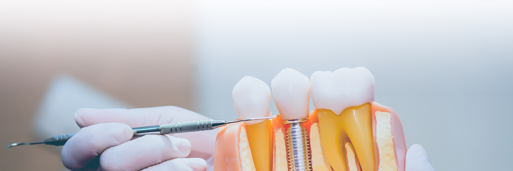 Dental Implants
