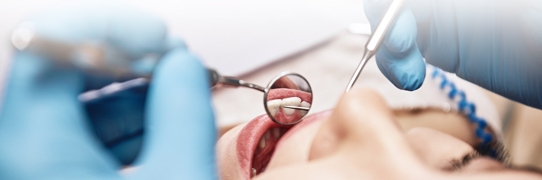 Apicoectomy